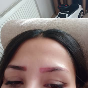 Batman Dilan Polat,2. Dereceden Yanık