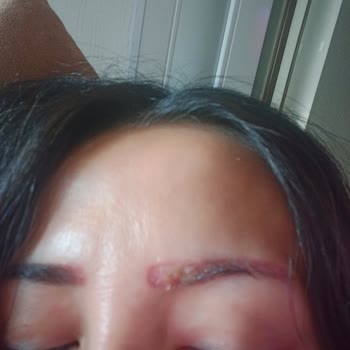 Batman Dilan Polat,2. Dereceden Yanık