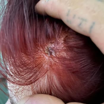 Palette Saç Derimin Yanması