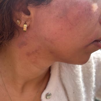 Turkeyana Clinic Lazer Epilasyon