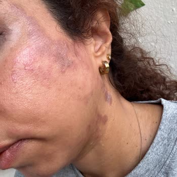 Turkeyana Clinic Lazer Epilasyon