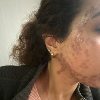 Turkeyana Clinic Lazer Epilasyon