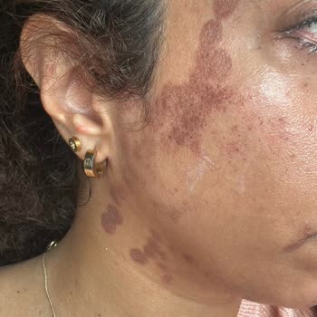 Turkeyana Clinic Lazer Epilasyon