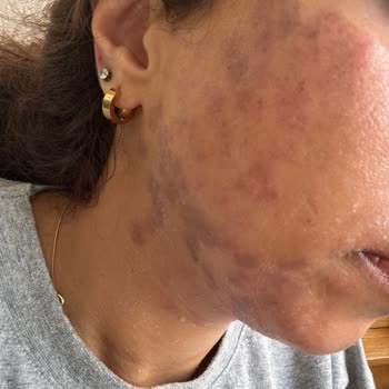 Turkeyana Clinic Lazer Epilasyon