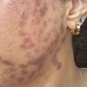 Turkeyana Clinic Lazer Epilasyon