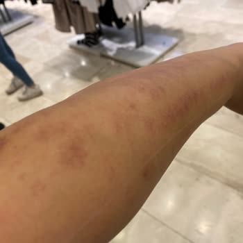 Elm Polikliniği Lazer Yanığı Su Toplama