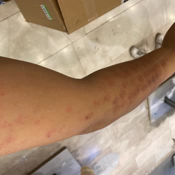 Elm Polikliniği Lazer Yanığı Su Toplama