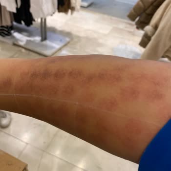 Elm Polikliniği Lazer Yanığı Su Toplama