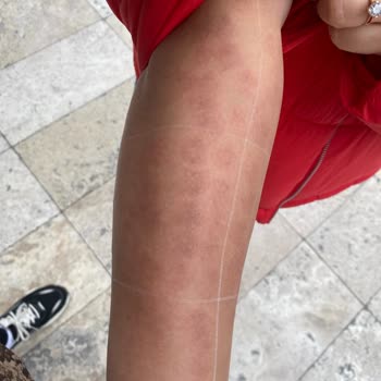 Elm Polikliniği Lazer Yanığı Su Toplama