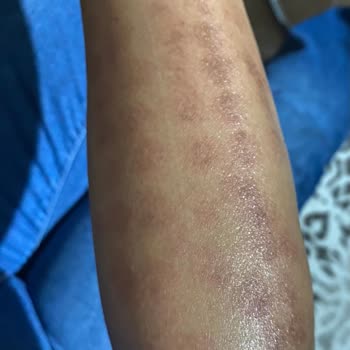 Elm Polikliniği Lazer Yanığı Su Toplama