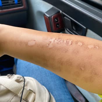 Elm Polikliniği Lazer Yanığı Su Toplama