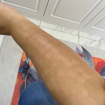 Elm Polikliniği Lazer Yanığı Su Toplama