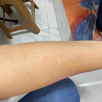 Elm Polikliniği Lazer Yanığı Su Toplama