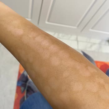 Elm Polikliniği Lazer Yanığı Su Toplama