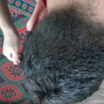 Vichy Kaşıntı Yara Kabuklanma