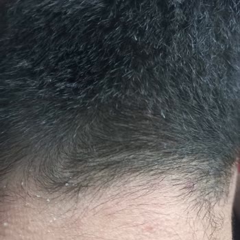 Vichy Kaşıntı Yara Kabuklanma