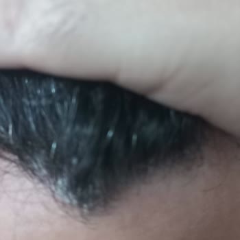 Vichy Kaşıntı Yara Kabuklanma