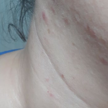 Hepsiburada Kollajen Ürününün Ciltte Sivilce Çıkarması
