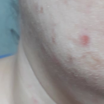 Hepsiburada Kollajen Ürününün Ciltte Sivilce Çıkarması