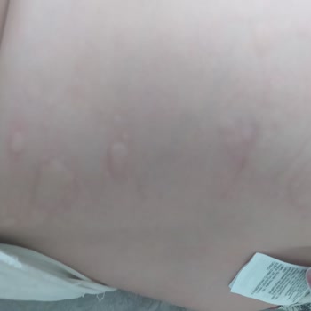 Ülker Cici Bebe Alerji Sorunu