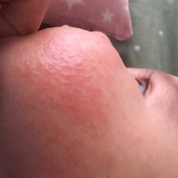Mustela Krem Yan Etki