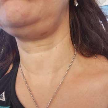 Dilan Polat Estetik Rasping İşlemi Sonucu Yanık Oluşumu