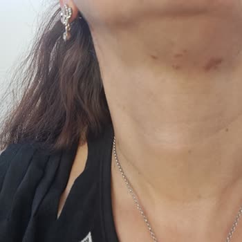 Dilan Polat Estetik Rasping İşlemi Sonucu Yanık Oluşumu