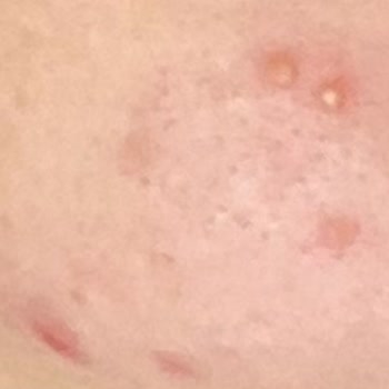 Rise & Shine Peeling Sivilce Yaptı