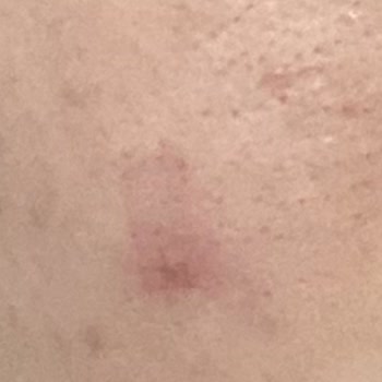 Rise & Shine Peeling Sivilce Yaptı