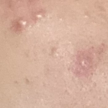 Rise & Shine Peeling Sivilce Yaptı