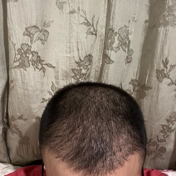 Emphair Saç Ekim Merkezi Saç Ekimi Sorunu