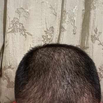 Emphair Saç Ekim Merkezi Saç Ekimi Sorunu