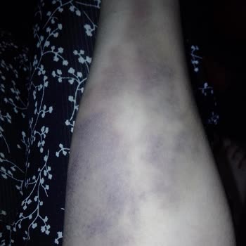 Alo 184 Sağlık Bakanlığı İletişim Merkezi Kandan Sonra Damar Patlaması