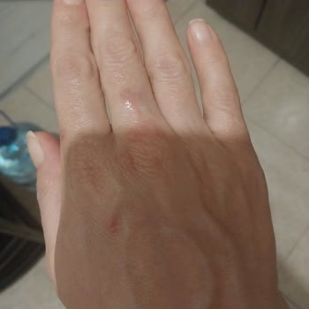 Fairy Bulaşık Deterjanı Alerji Yapıyor