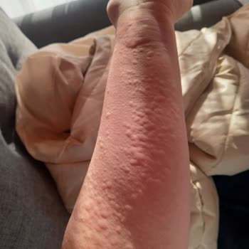 Perwoll Deterjan Sebebiyle Tüm Vücudumda Kabartılar Meydana Geldi