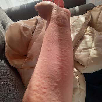 Perwoll Deterjan Sebebiyle Tüm Vücudumda Kabartılar Meydana Geldi