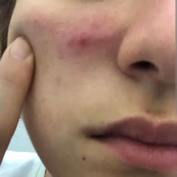 Kiperin Collagen Kiperin Kolajen Mide Ve Sivilce Şikayeti