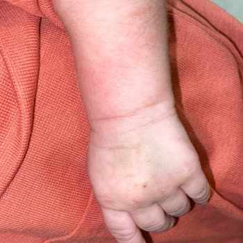 Mmt Amerikan Hastaneleri İlgisiz Personel