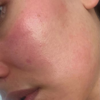 La Roche-Posay Serum Kullanımı Sonrası Ciddi Kızarıklık