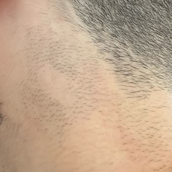 Pien Estetik Klinik Hiçbir İşe Yaramayan Lazer Epilasyon