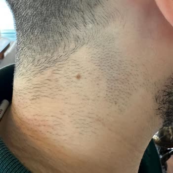 Pien Estetik Klinik Hiçbir İşe Yaramayan Lazer Epilasyon