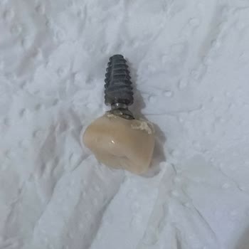 Özel Bağcılar Ağız ve Diş Sağlığı Polikliniği Bir Buçuk Ayda Ağrıyan Ve Sallanan İmplant Modeli