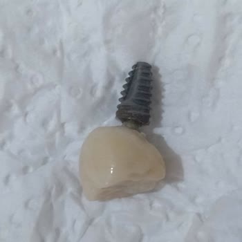 Özel Bağcılar Ağız ve Diş Sağlığı Polikliniği Bir Buçuk Ayda Ağrıyan Ve Sallanan İmplant Modeli