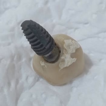 Özel Bağcılar Ağız ve Diş Sağlığı Polikliniği Bir Buçuk Ayda Ağrıyan Ve Sallanan İmplant Modeli