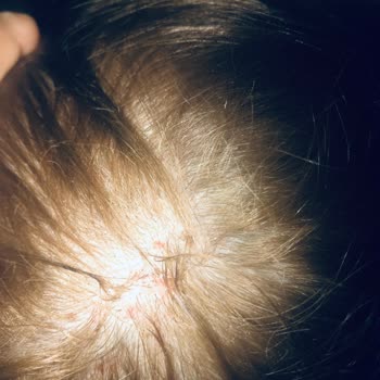 Palette Saç Derisi Yanması