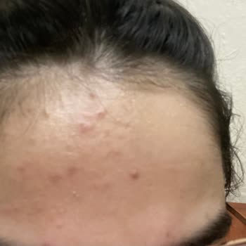 Watsons Marka Şampuan Sivilce Yaptı