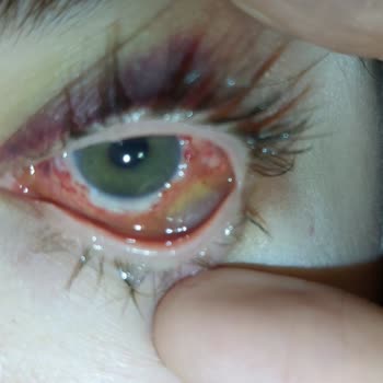 Dünya Göz Hastanesi Hastanenin Sorumsuzluğu Gözlerimi Kaybetmek Üzereyim