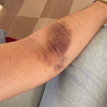 Medical Park Hastanesi Kolumda Flebit Oluşmasına Rağmen Serum Verdiler!