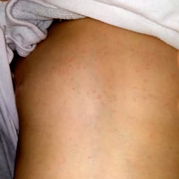 Mustela Göğüs Balsamı Sonrası Vücutta Kırmızı Lekeler Ve Kabarmalar