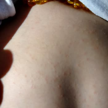 Mustela Göğüs Balsamı Sonrası Vücutta Kırmızı Lekeler Ve Kabarmalar